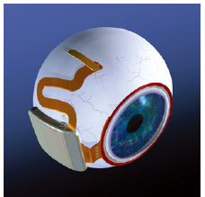 图2,波士顿视网膜植入项目的研究人员在一头猪的视网膜下区域植入了一个阵列，但把假体的大部分（一个钛制的密封电子组件）装在巩膜的表面。