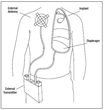 图7,呼吸起搏器带有用于膈神经刺激的植入电极以及RF接收器，还有向植入体发射RF信号的外部天线，完成刺激起搏功能